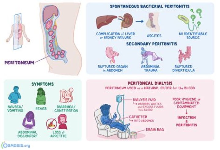 Qué es la peritonitis: síntomas, complicaciones y tratamiento